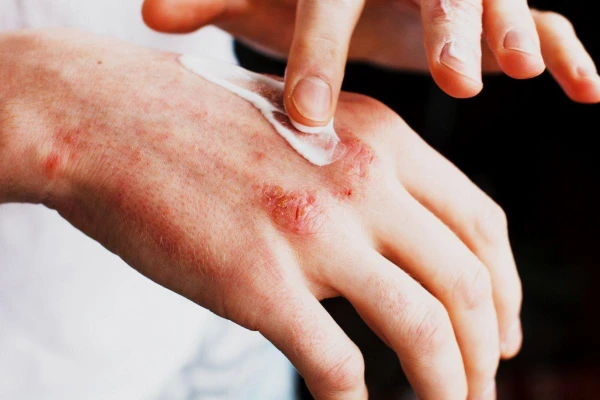 Alergia skórna – czym jest i jak łagodzić jej objawy?