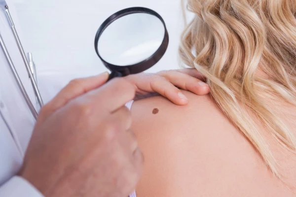 Dermatoskopia - jak wygląda badanie znamion i pieprzyków?