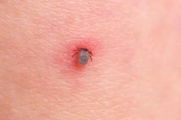 Jakie badania na boreliozę?